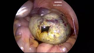 Ovarian Torsion by Dr Gajanan Patil  Kewal Hospital  Laparoscopy Training [upl. by Atilal]