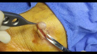 A Solitary Fibrous  Cellular type Tumor of the AnkleExcision [upl. by Llerreg507]