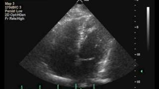 Apical Trabeculation [upl. by Osnola]