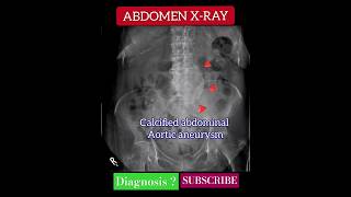 Calcified abdominal aortic aneurysm  X Ray Abdomen  Radiology [upl. by Nipsirc]