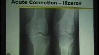 Lecture  High Tibial Osteotomy for Knee Arthritis  Part 3 [upl. by Atinnek98]