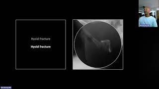 Fractures of the Cervical Spine  Free Radiology CME [upl. by Aneerol]