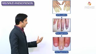 Raynauds phenomenon  Raynauds disease amp Raynauds syndrome [upl. by Wolfy984]