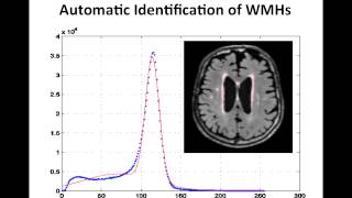 Resolving the White Matter Hyperintensity Prenumbra using FLAIR and Diffusion [upl. by Ennasil]