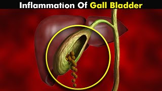 Cholecystitis Gallbladder Inflammation  Symptoms Causes and Treatment UrduHindi [upl. by Linoel125]