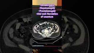 Cholelithiasis Hepatomegaly Prostatomegaly Abd wall Herniation of omentum trending ctscan [upl. by Wrightson]