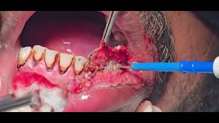 Verrucous carcinoma lip excision cautery laser  Dr Hitesh Patel [upl. by Brest]