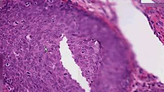 Oral squamous cell carcinoma  Etiology and Pathogenesis [upl. by Sheeree]