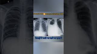 Diffrence between Normal Chest X ray ampPleural effusion medicalimaging xray radiology [upl. by Holly-Anne]