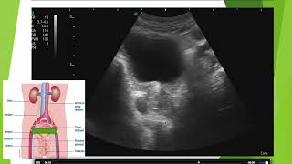 Cancer de prostate en échographie [upl. by Kceb]