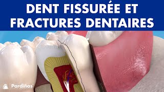 DENTS CASSÉES  Symptômes et types dents fissurées et fractures dentaires © [upl. by Einhapets194]