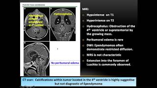 Pediatric Ependymoma Genetics Molecular Classifications and Role of RadiationDr Tanweer Shahid [upl. by Acino851]