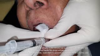 intraligamentary local anaesthesia technique by using conventional syringe by dr nishit kumar shah [upl. by Idroj]