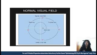 Visual Field Defects in Glaucoma  Dr Niha Aggarwal [upl. by Sudnor560]