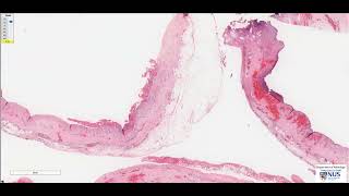 Heart Fibrinous pericarditis Microscopy  Talking Slide [upl. by Glarum]