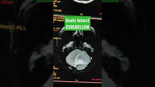 Large Acute Infarct in Cerebellum viral youtubeshorts mri [upl. by Hinda]