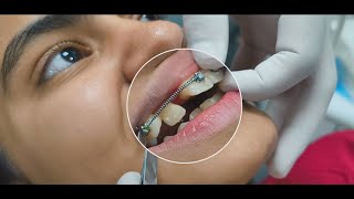 Correcting a BlockedOut Lateral Incisor Treatment Options and Solutions orthodontics [upl. by Dev]