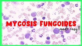 Mycosis Fungoides  WBC disorders  Sezary Syndrome [upl. by Kale]