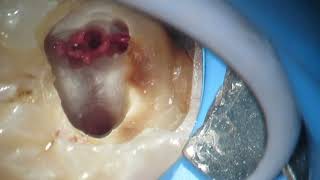 pulpitis irreversible asintomática en molar inferior tratamiento en una cita [upl. by Erodasi178]