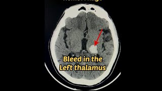 Hypertensive Intraparanchymal hemorrhage  Brain 🧠 bleed 🩸 Radiology hemorrhage brain [upl. by Trish46]