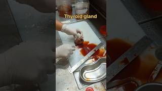 Cystic thyroid gland gross pathology [upl. by Anizor]