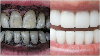 3 Way to Whiten Your Yellow Teeth Naturally [upl. by Noni]