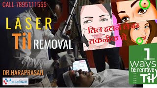 Laser Til ampMole Removal by Nd YAG Laser अनचाहे तिलों को हटाए मिनटों मेंGlobal Health Aesthetics [upl. by Atilem495]