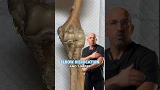 2nd Most Common Large Joint Dislocation Is it the most painful shorts [upl. by Yaron]