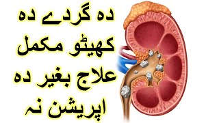 kidney stones complete treatment with homeopathic medicine [upl. by Galligan153]