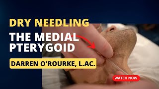 Dry Needling The Medial Pterygoid [upl. by Cuhp]