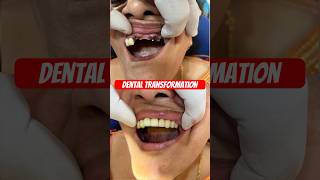 Dental transformation  Amazing transformation  Dental bridge 😍 viral dentist [upl. by Dobrinsky38]