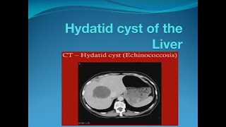 Hydatid cyst of the liver [upl. by Araem]