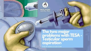 The 2 Major Problems with TESA Testicular Sperm Aspiration drmalpani malpaninifertilityclinic [upl. by Noivart]