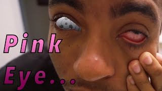 Pink Eye Conjunctivitis Apple Cider Vinegar Home Remedy [upl. by Nicolea]