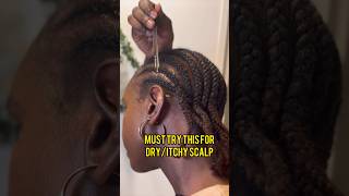 Must Try this for Itchy scalp [upl. by Bowes616]