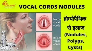 Vocal Cord Lesion galekagath  Nodules Polyps and Cysts  Brahm Homeo  Dr Pradeep [upl. by Jacky]