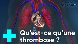 La thrombose veineuse  Le Magazine de la Santé [upl. by Brest]