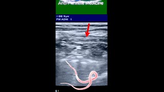 Long Ascaris Worm  in Small Intestine of 8 yrs Old Boy ultrasound [upl. by Alveta513]