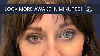 Get a NonSurgical Instant Eyelid Lift with Upneeq Eye Drops [upl. by Susannah]