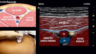 Adductor Canal Block Saphenous Nerve  UltrasoundGuided Demonstration [upl. by Eissirc459]