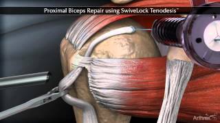 Proximal Biceps Repair using SwiveLock Tenodesis [upl. by Taran]