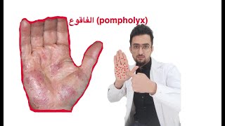 pompholyx مرض الفاقوع [upl. by Namrej]