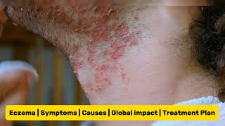 Eczema  Causes of Eczema  Symptoms of Eczema  Treatment of Eczema  Skin Disease [upl. by Sidwohl]