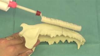 Acrylx ESF Acrylic  Mandibular Fracture Repair [upl. by Anma]