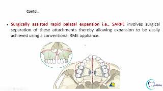 Arch expansion in orthodontics part 2 made easy  Orthodontics  Dentophile [upl. by Ayal335]