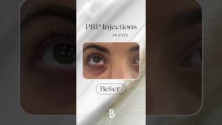 Before amp After Results of PRP Injections for Brighter Firmer Eyes [upl. by Aivilys]