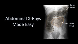 Abdominal XRays Made Easy [upl. by Flavian57]