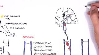 Deep vein thrombosis Quick Review [upl. by Ellednahs546]