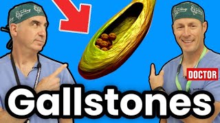 How To Get Rid Of Gallstones And Cholecystitis [upl. by Knoll962]