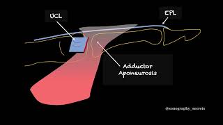 STENER Lesion ultrasound [upl. by Jaycee]